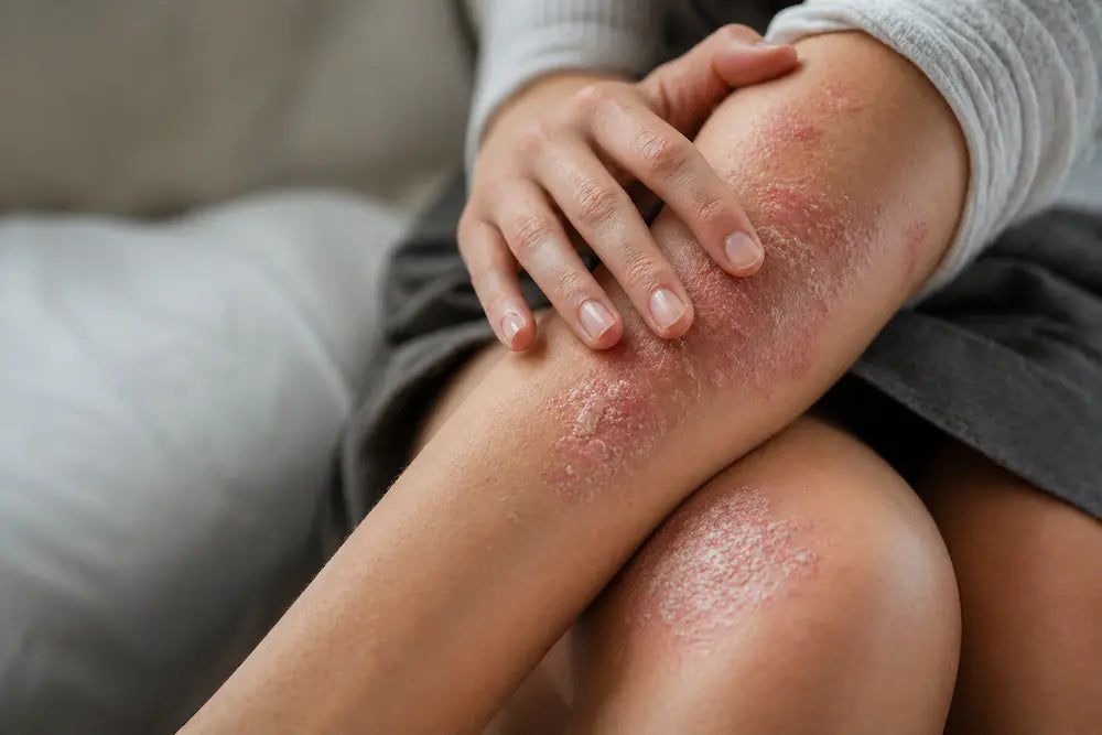 Psoriasis am Körper - Apotheke Zaversky